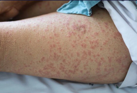 Skin rash allergy